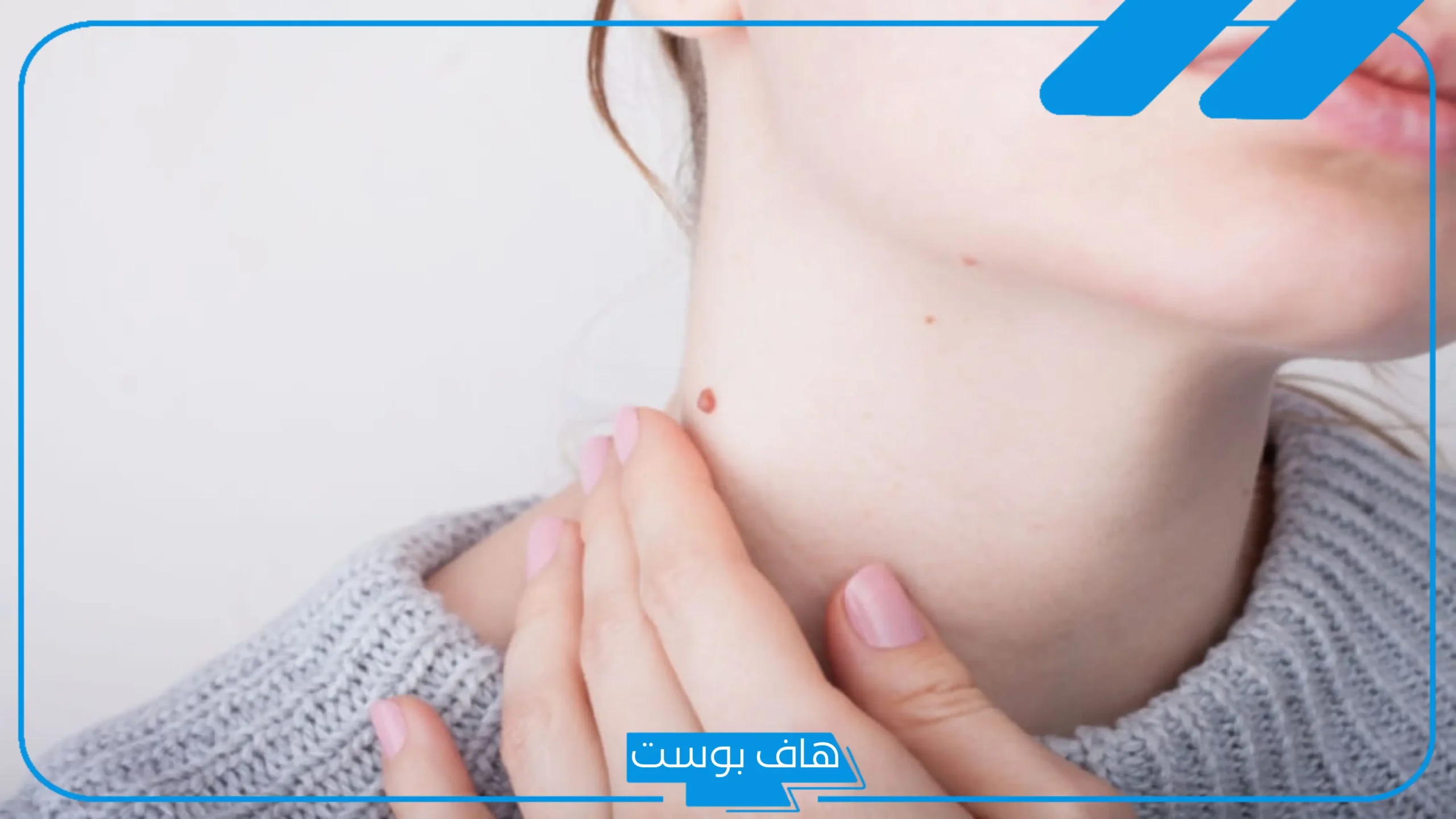 تجربتي مع محلول افوماك لإزالة الزوائد الجلدية