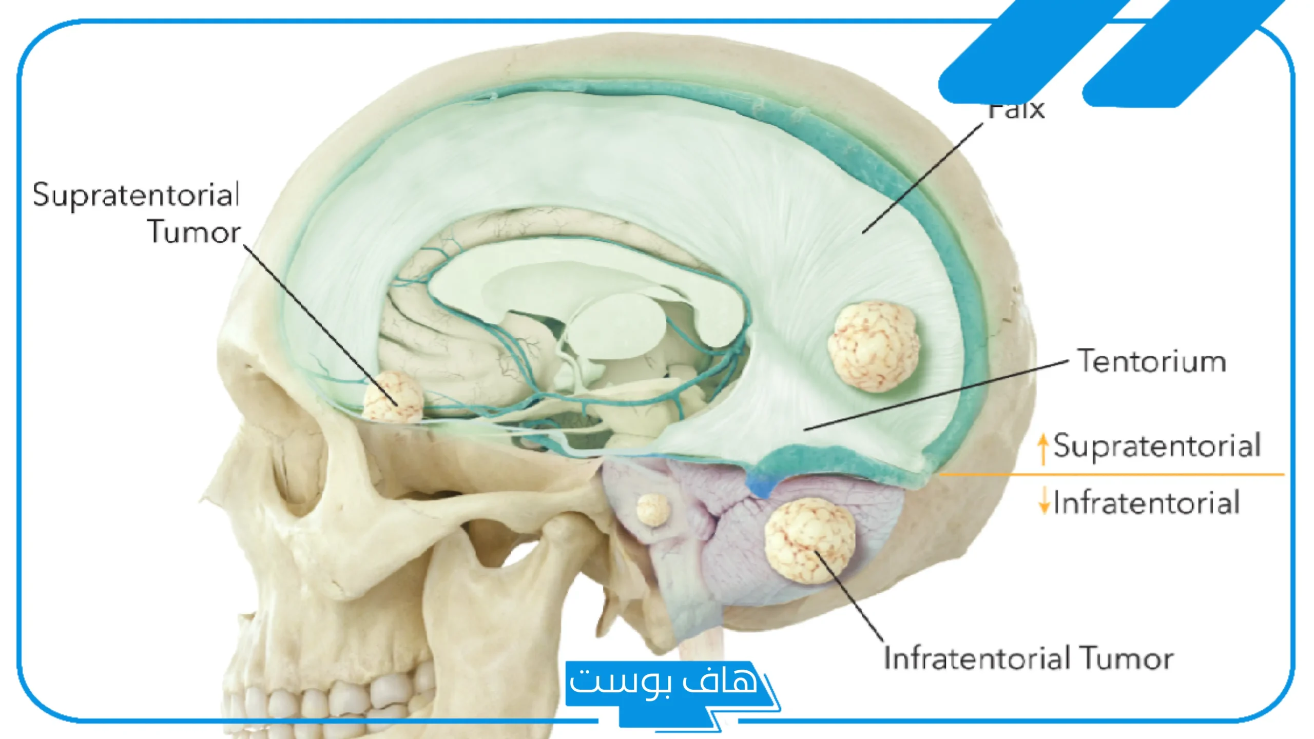 تجربتي مع ورم الدماغ كاملة بالأعراض والمضاعفات المحتملة