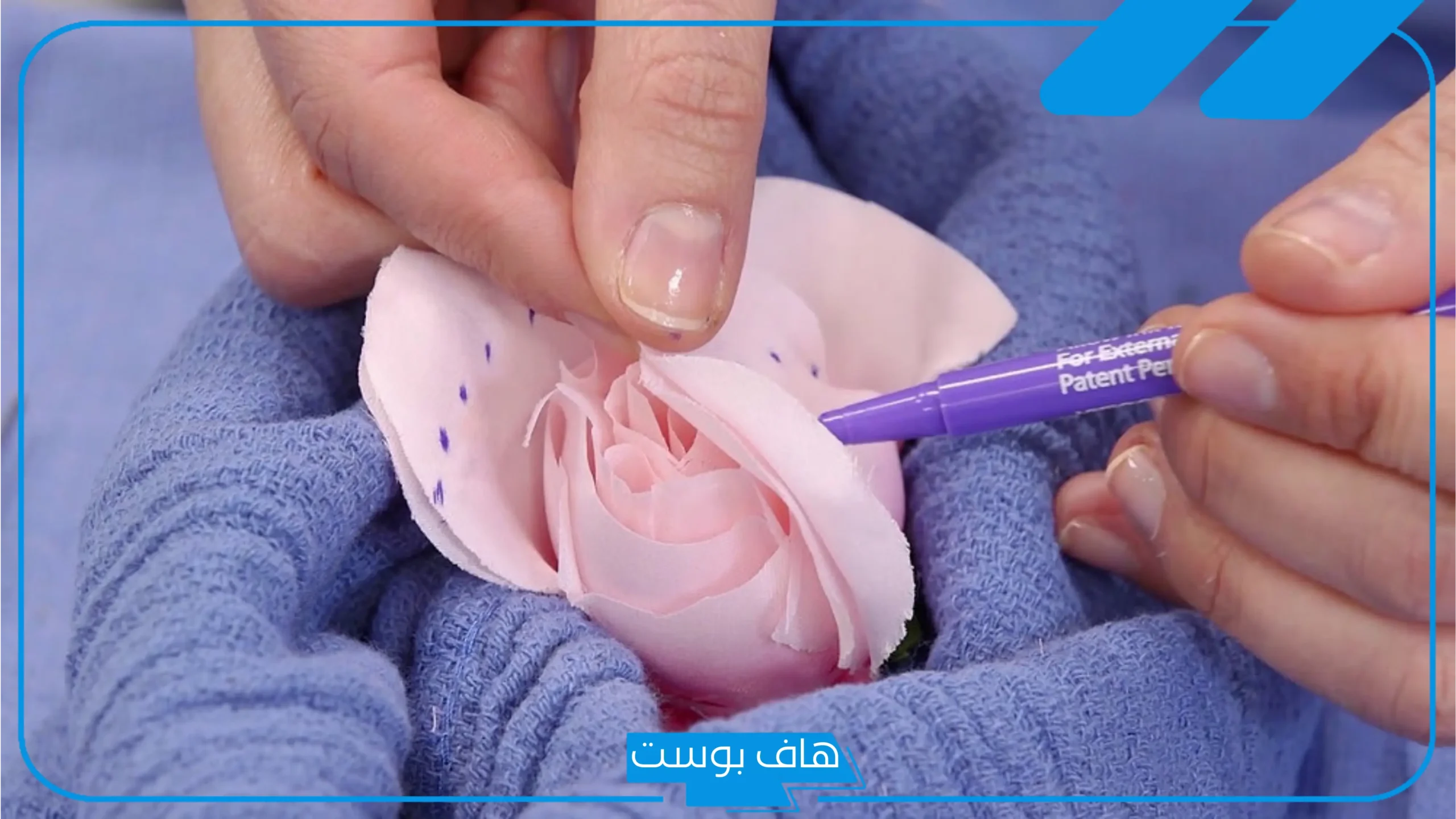 تجربتي مع عملية تجميل الاشفار عالم حواء كاملة بالمميزات والسلبيات