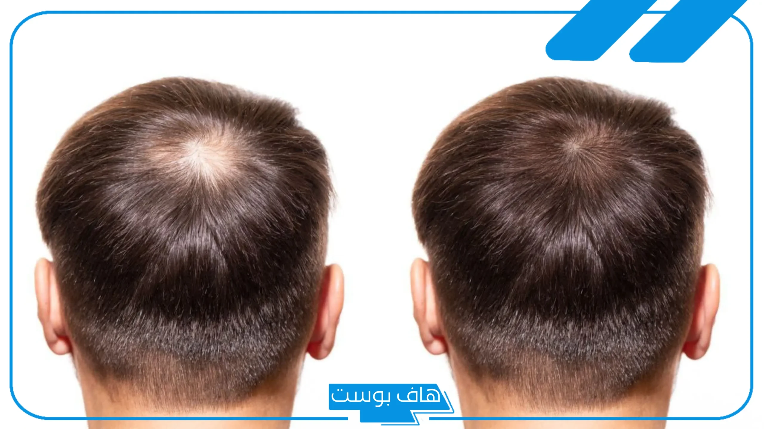 تجربتي مع الريجينيرا كاملة بالفوائد لعلاج الصلع الوراثي