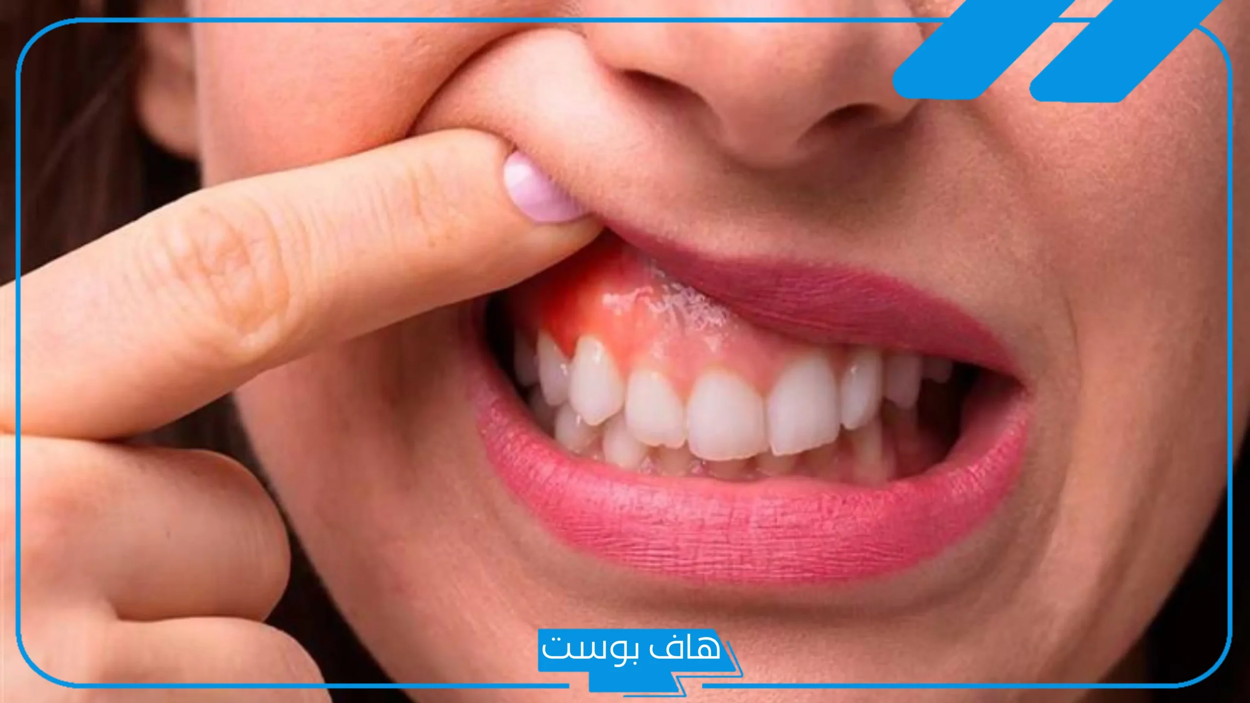 تجربتي مع انحسار اللثه قبل وبعد، نسبة نجاح عملية زراعة اللثة