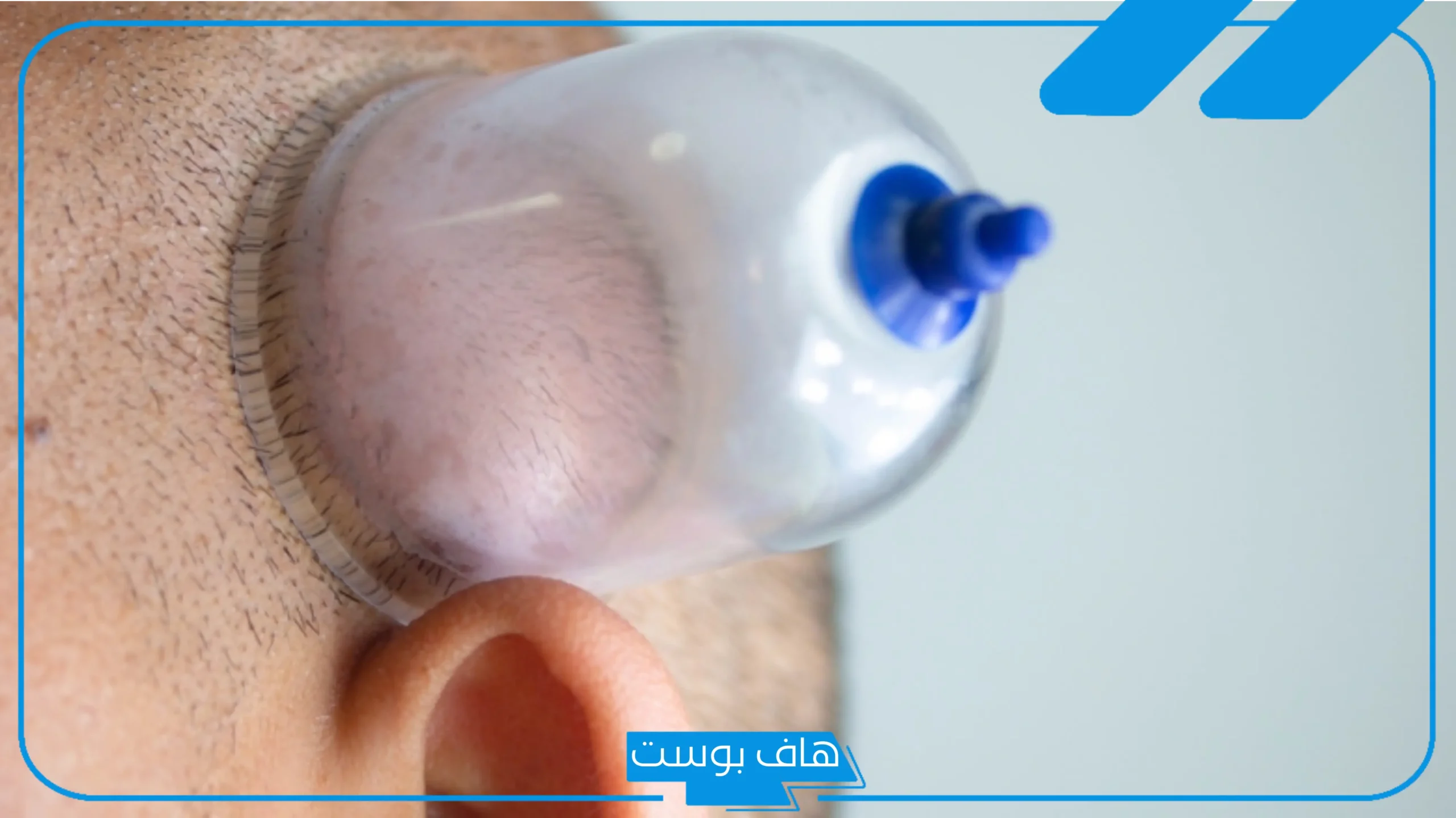 تجربتي مع حجامة الراس وما هي النتائج بالفوائد والنصائح