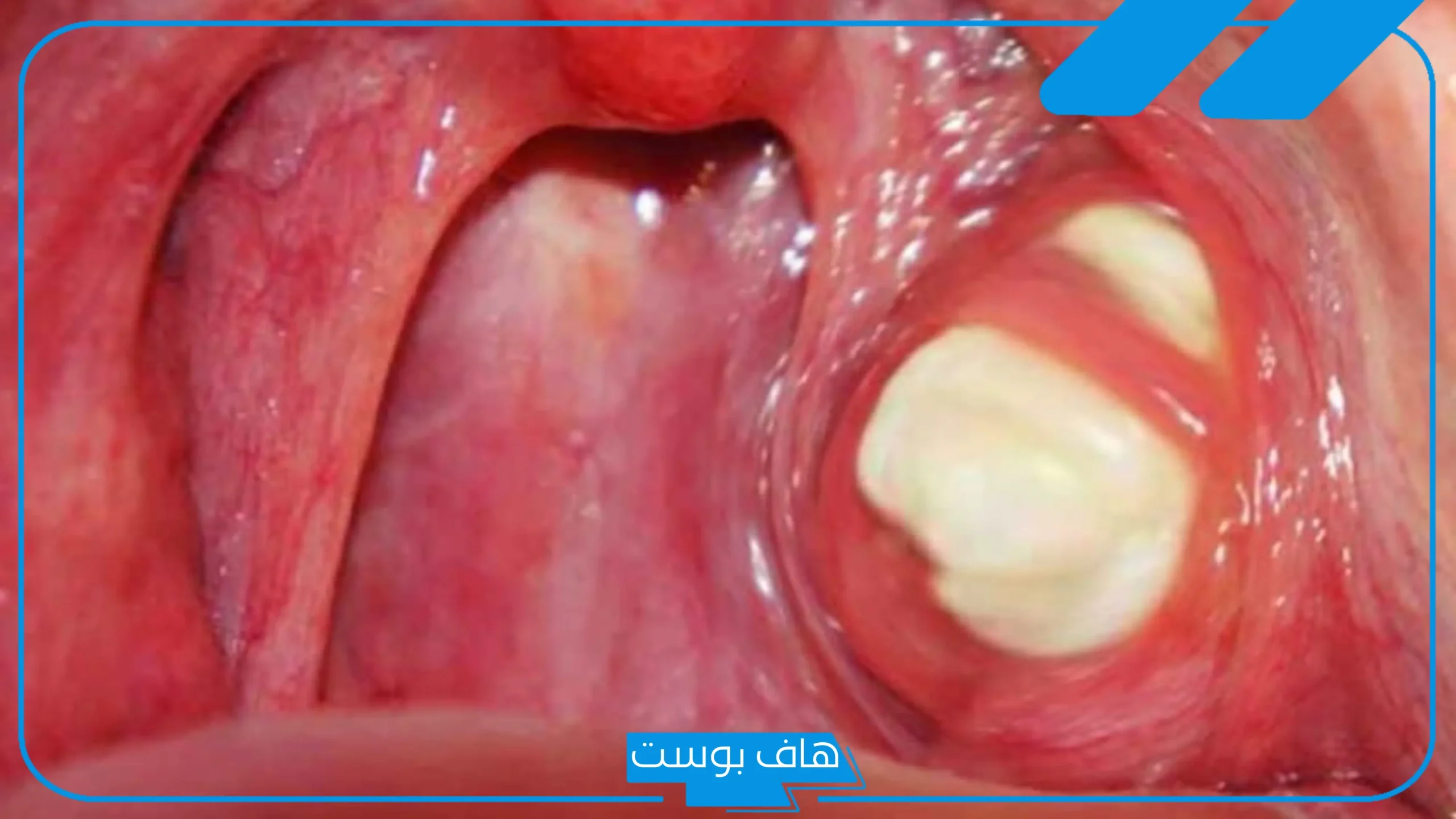 تجربتي مع حصوات اللوز بالأعراض وأسباب تكونها