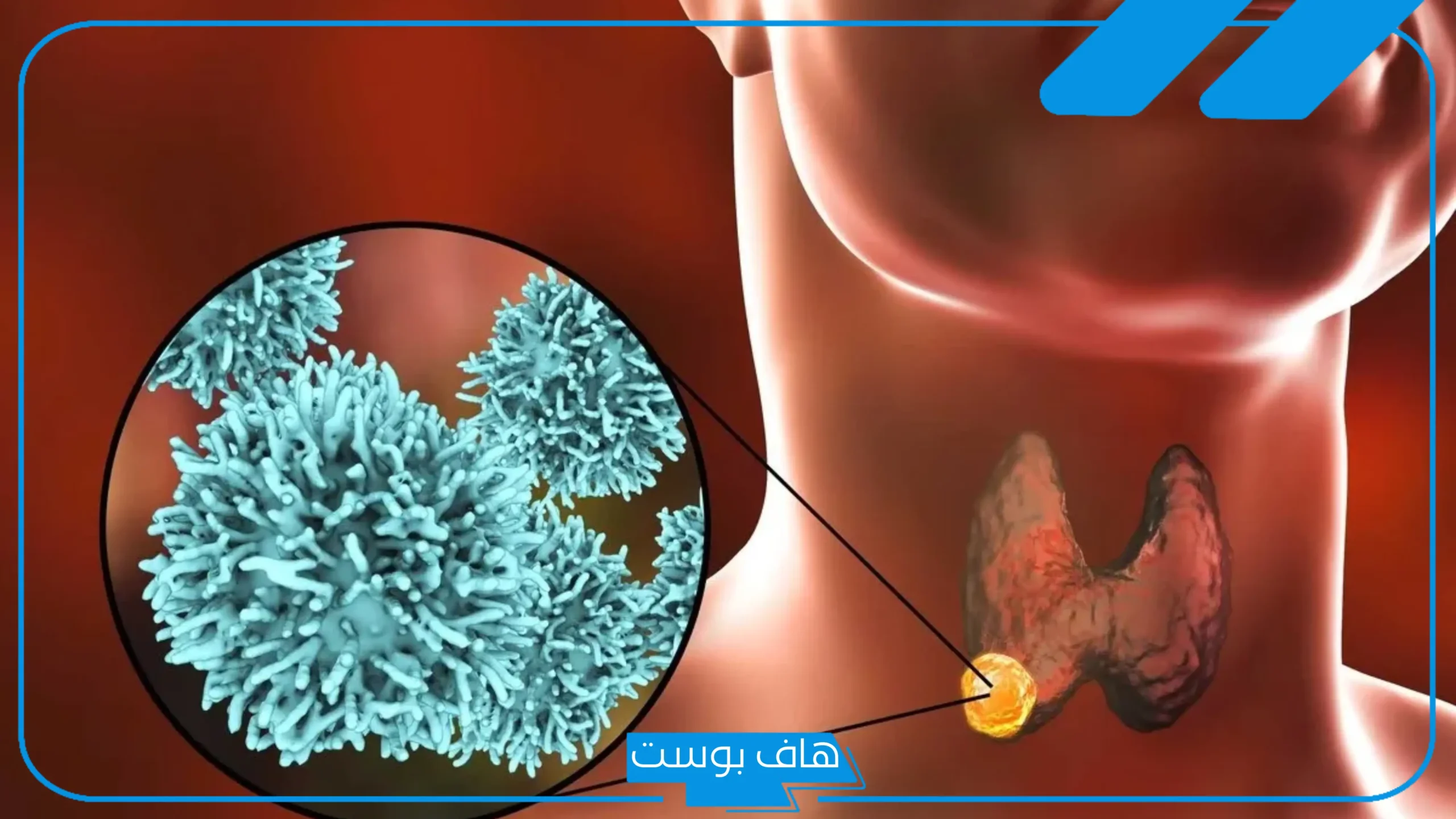 تجربتي مع سرطان الغدد اللمفاوية وخطورته الصحية