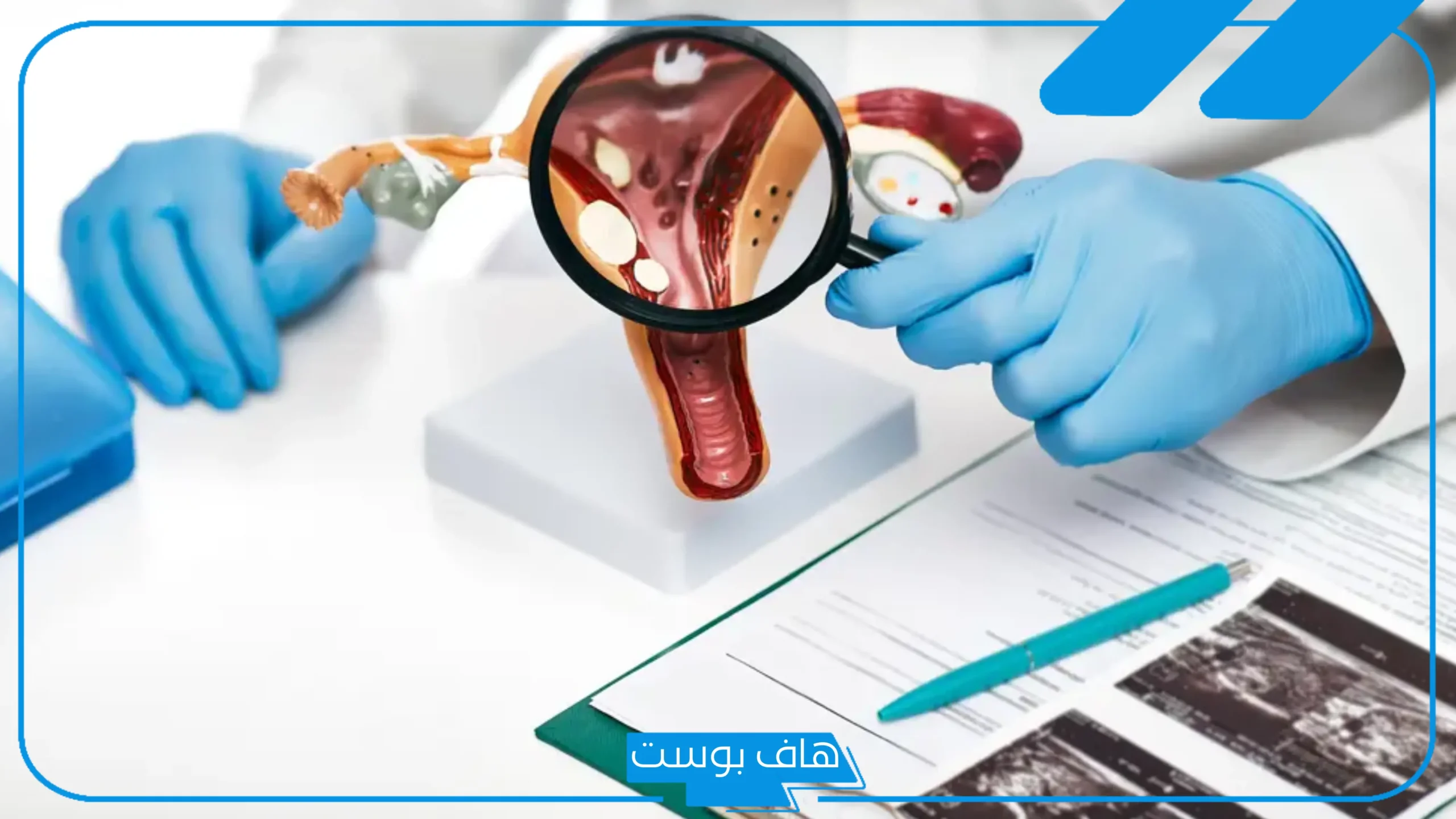 تجربتي مع لحمية الرحم الأعراض والمضاعفات، طريقة إزالة لحمية الرحم بالأعشاب