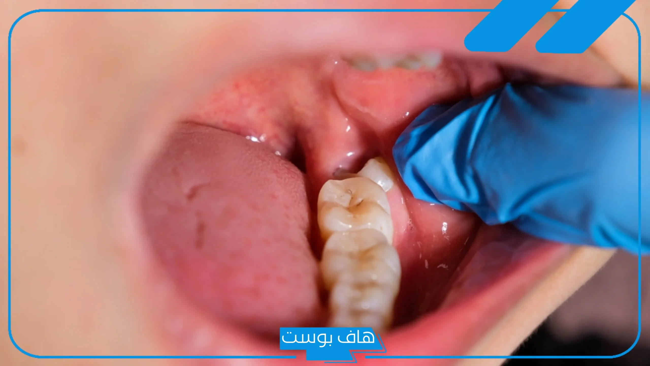 تفسير حلم خلع الضرس العلوي في المنام للرجل والمرأة العزباء والمتزوجة