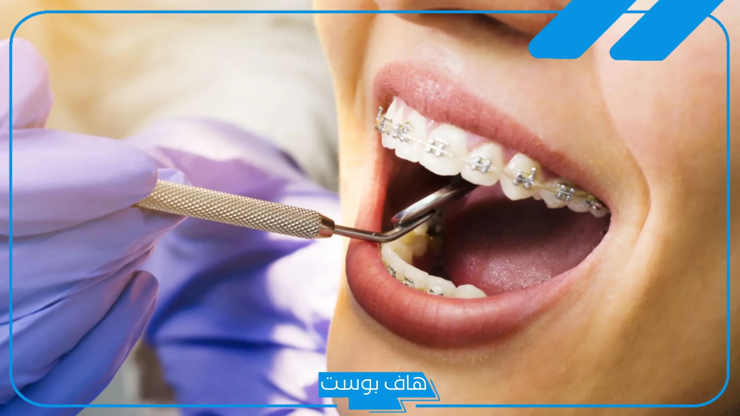 تفسير خلع الضرس في المنام دون أي ألم لكبار المفسرين للمتزوجة والعزباء