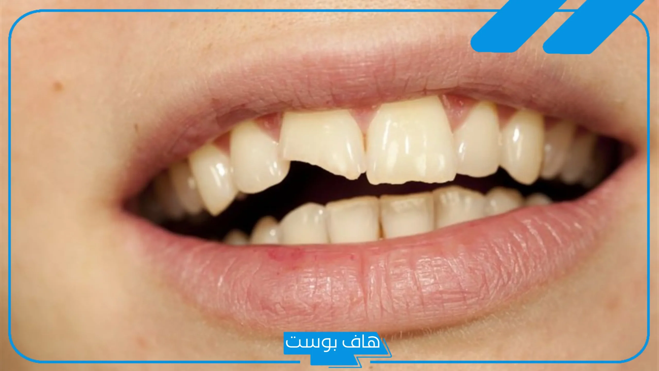 تفسير حلم كسر السن السفلي وخلعه في المنام لابن سيرين للمتزوجة