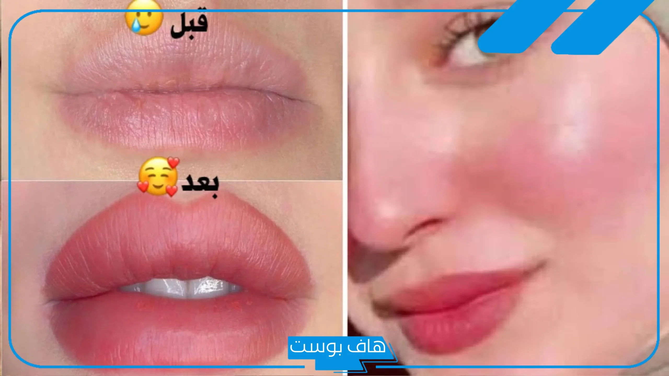 تجربتي مع توريد الشفايف بالليزر وأهم النصائح