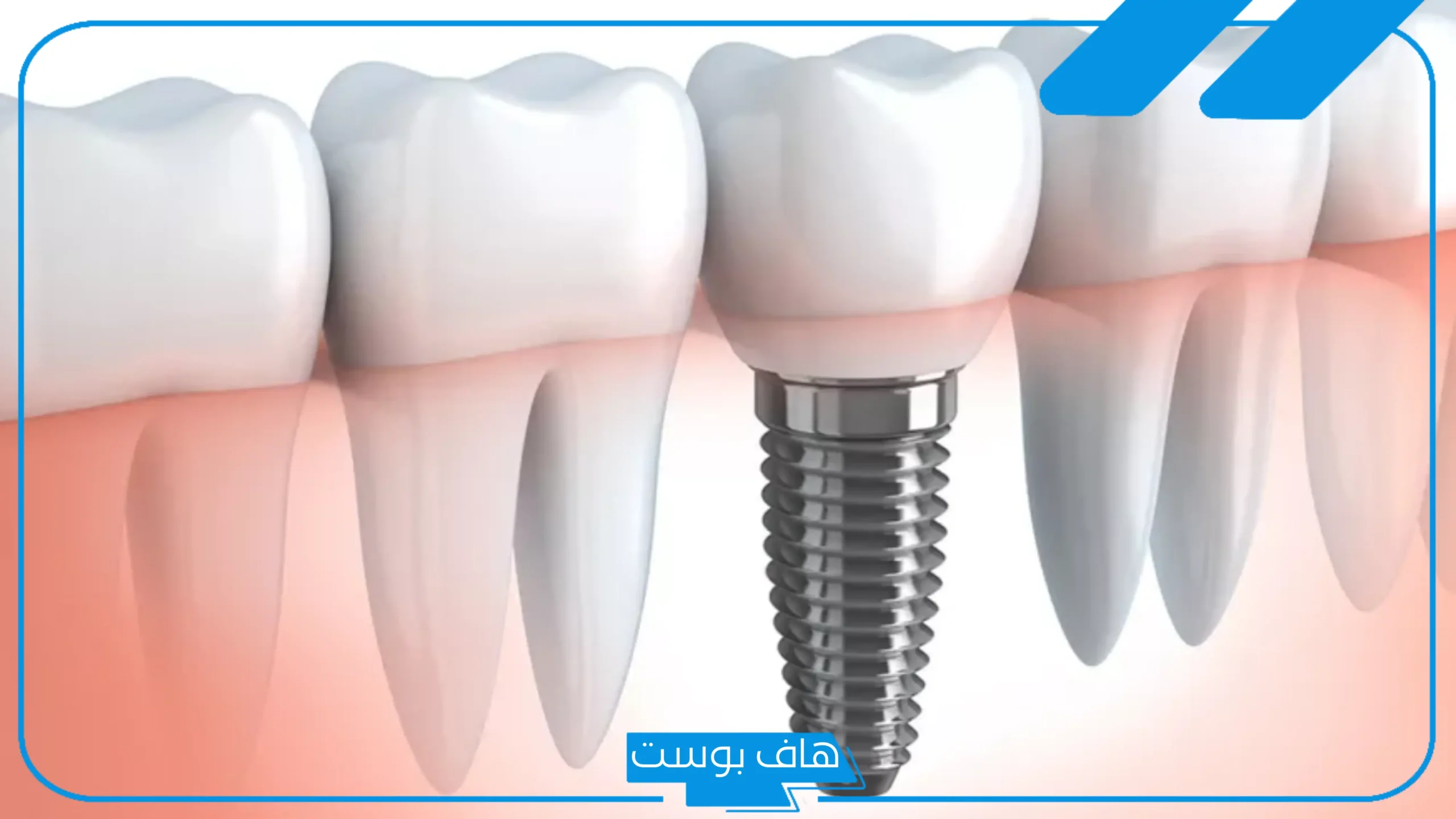 تجربتي مع زراعة الاسنان كاملة لابتسامة جميلة، هل زراعة الأسنان تؤلم؟