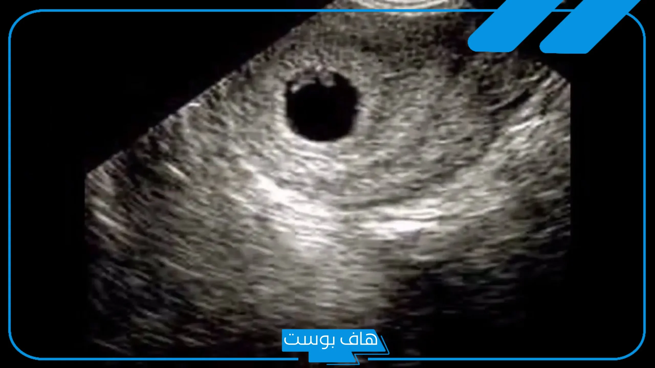 تجربتي في تأخر ظهور الجنين في كيس الحمل رغم الاختبار