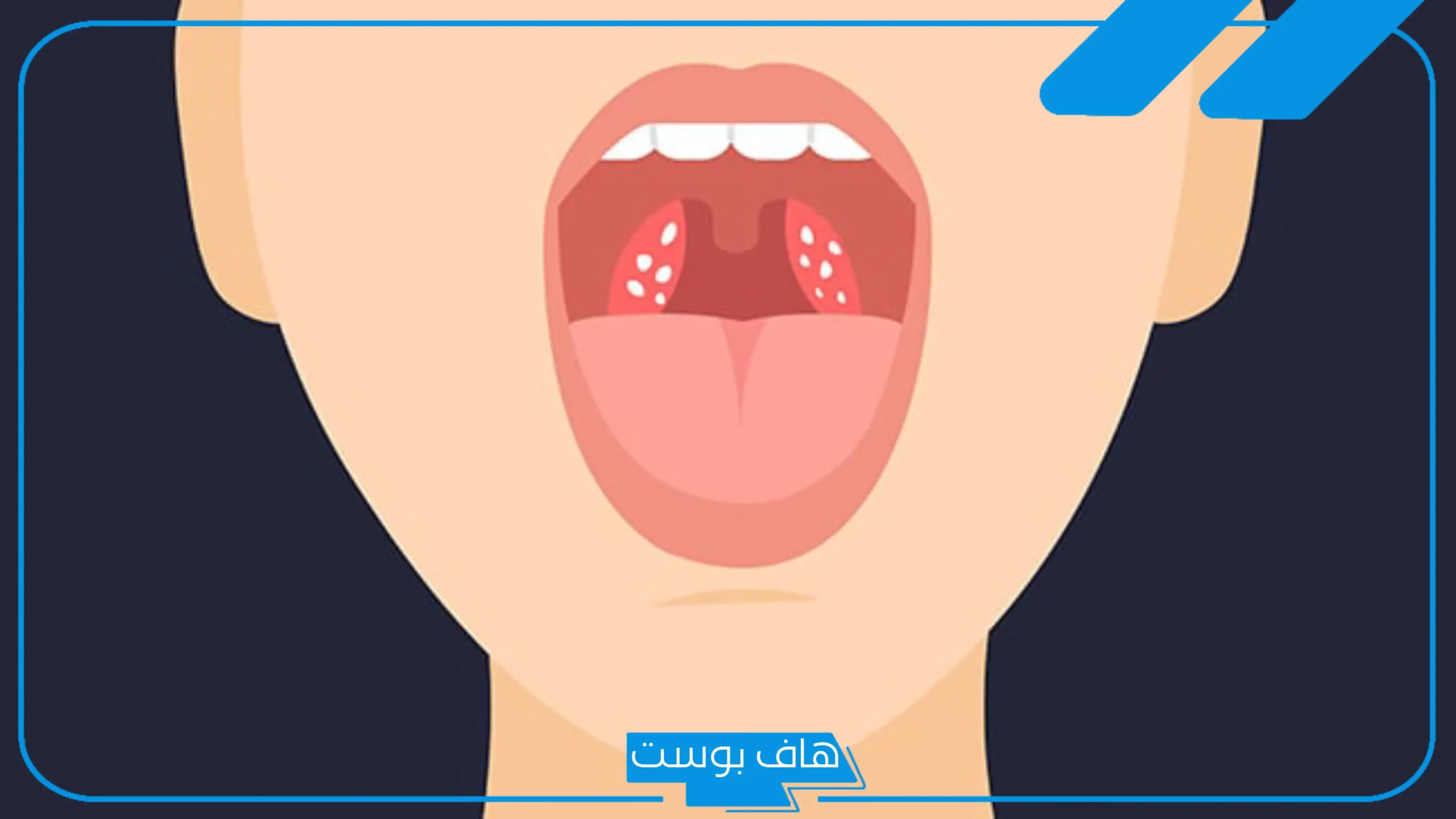 تجربتي مع حصوات اللوز بالأعراض وأسباب تكونها