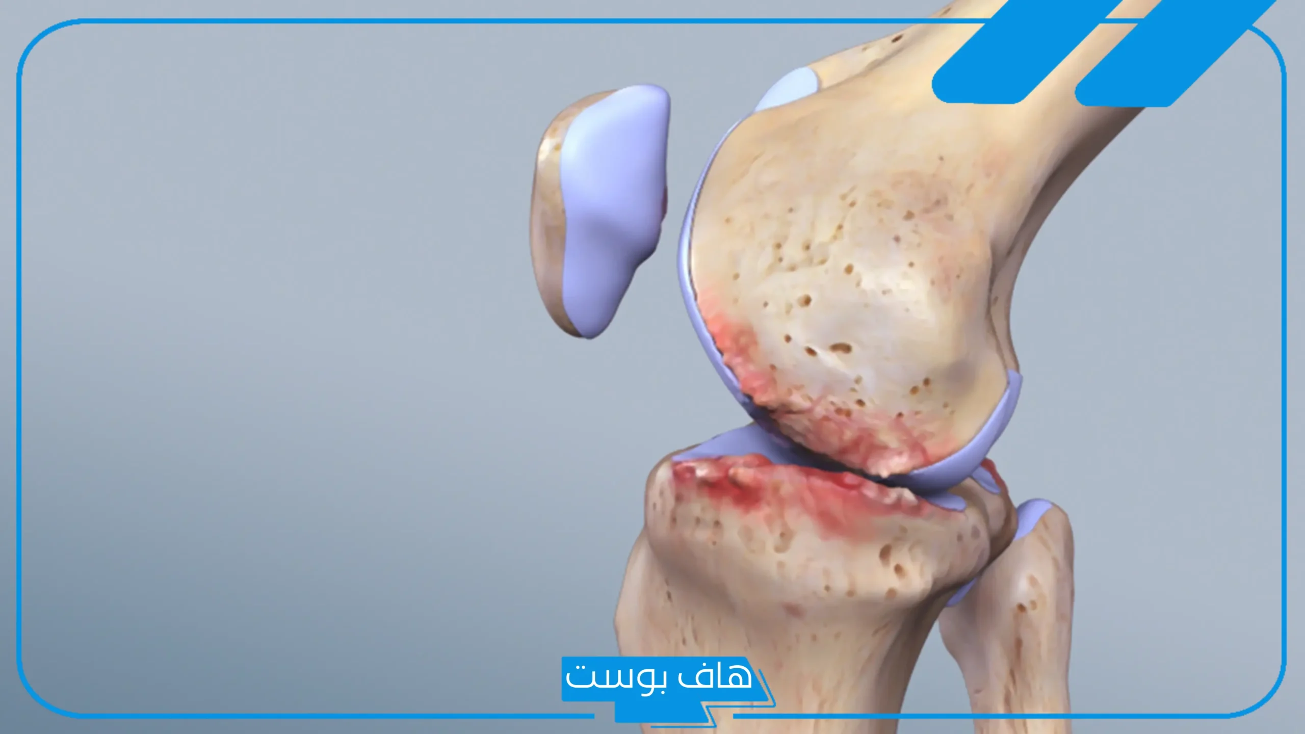 تجربتي في علاج خشونة الركبه بدون جراحة
