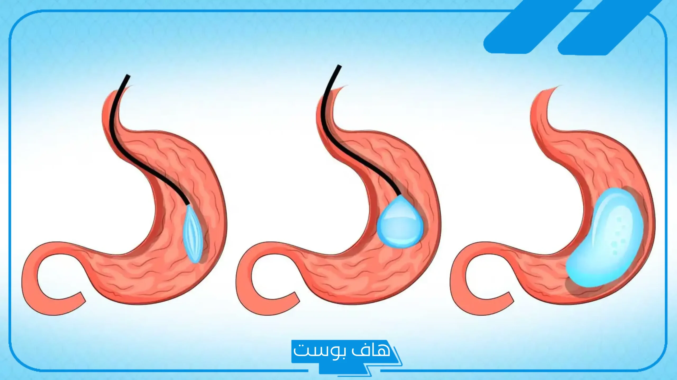 تجربتي مع بالون المعدة بالمميزات والفوائد وأسباب فشله
