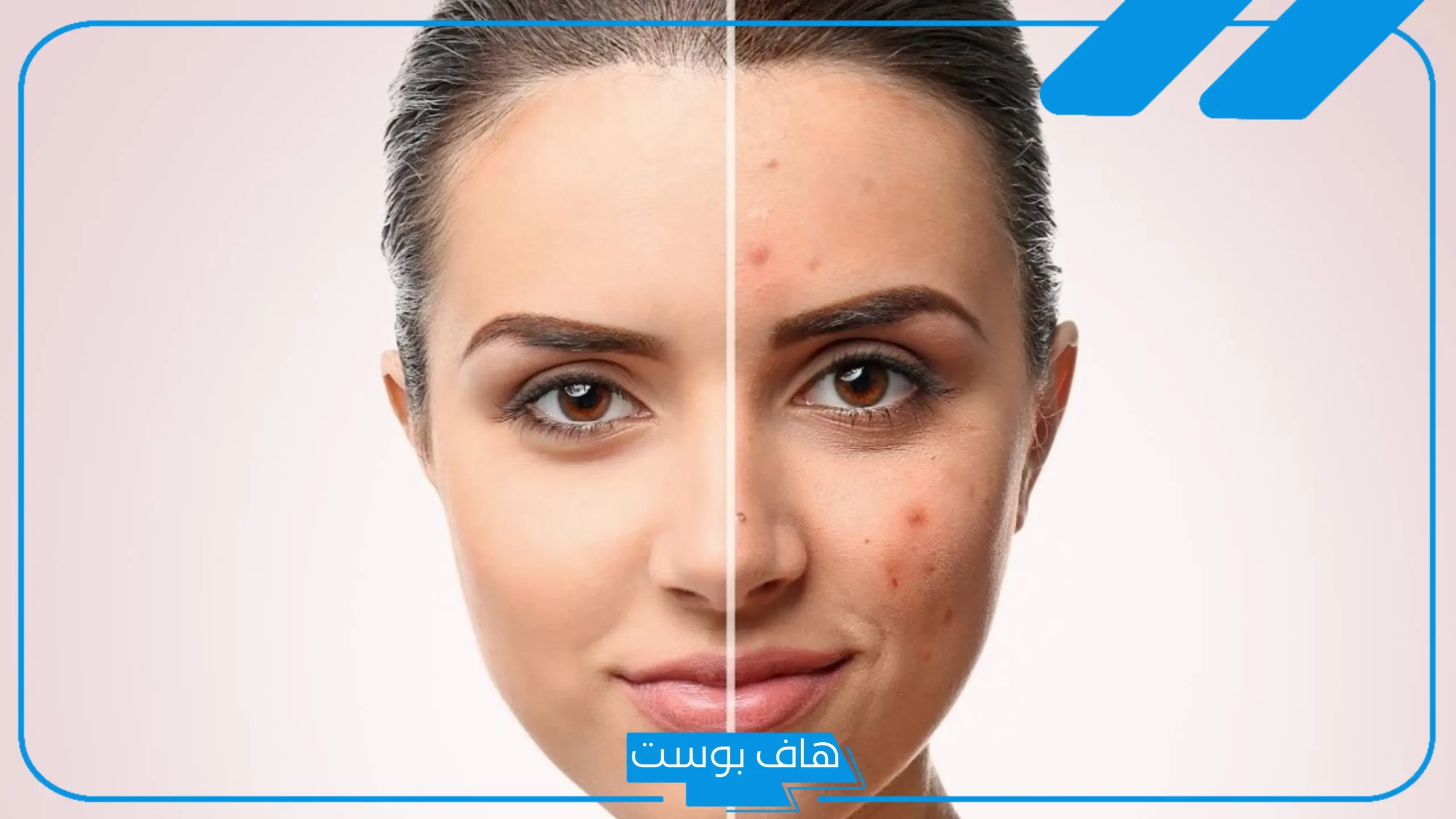 تجربتي مع فراكشنال ليزر للوجه وإزالة الندبات