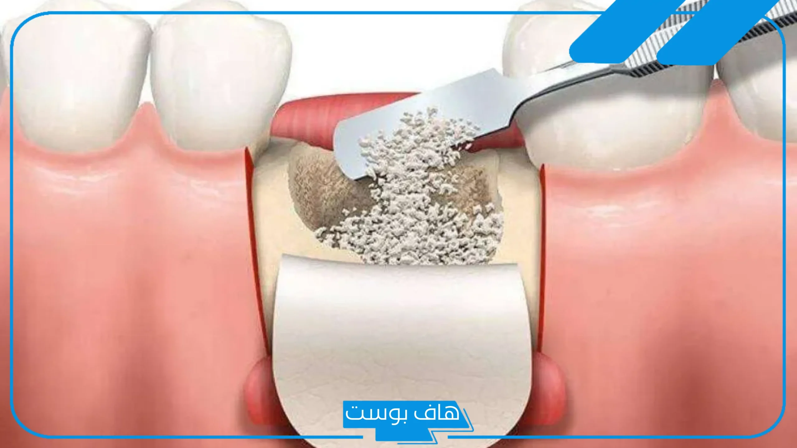 تجربتي مع زراعة عظم الفك كاملة ونسب النجاح، بديل زراعة عظم الفك