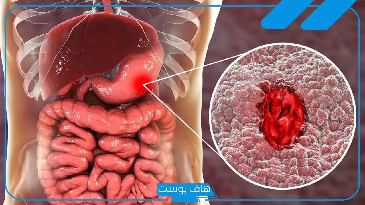 تجربتي في علاج قرحة المعدة وأسبابها.. هل يمكن الشفاء من قرحة المعدة ؟