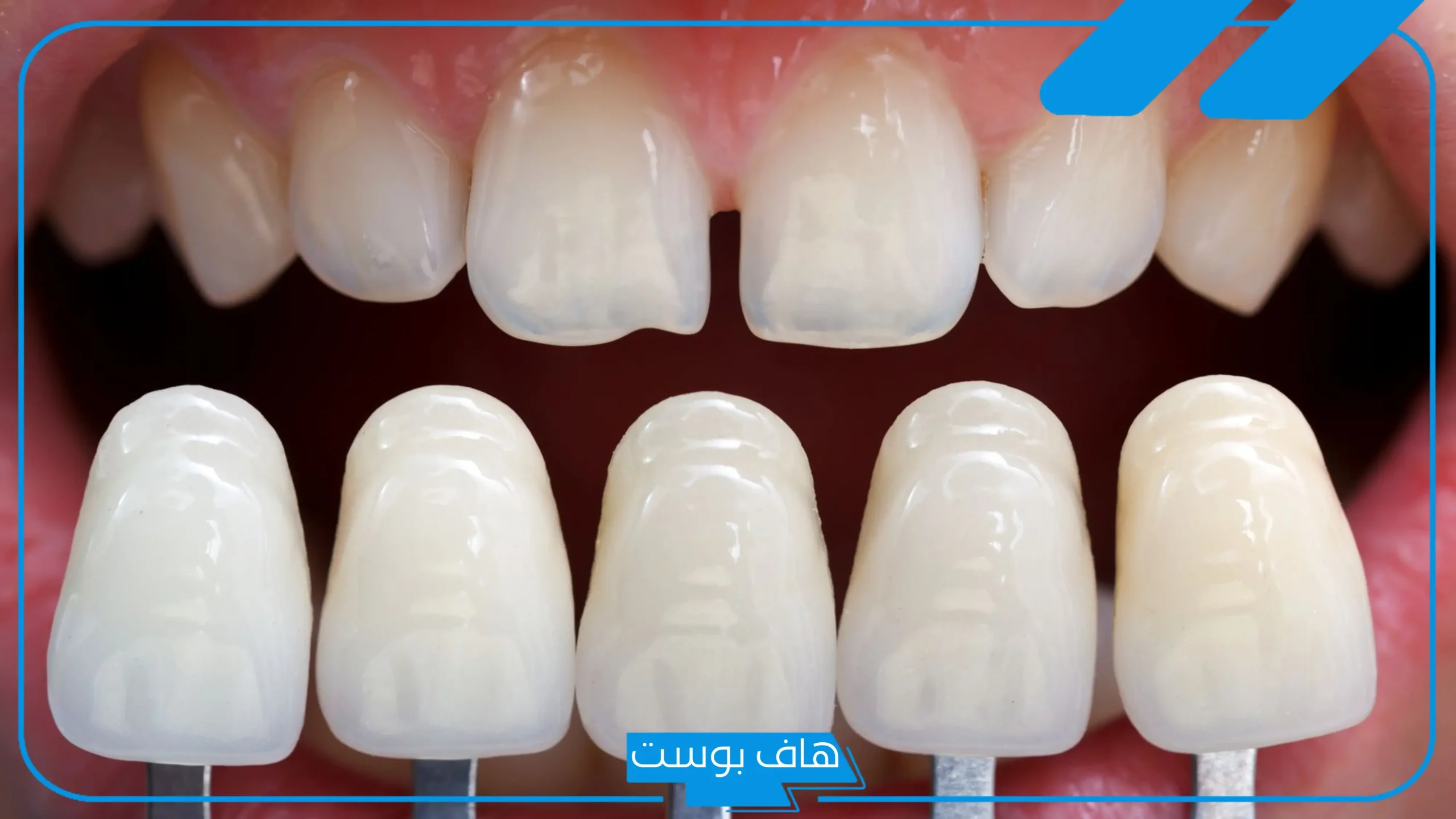 تجربتي مع عدسات الاسنان، جميع أنواع عدسات الأسنان وأفضلها