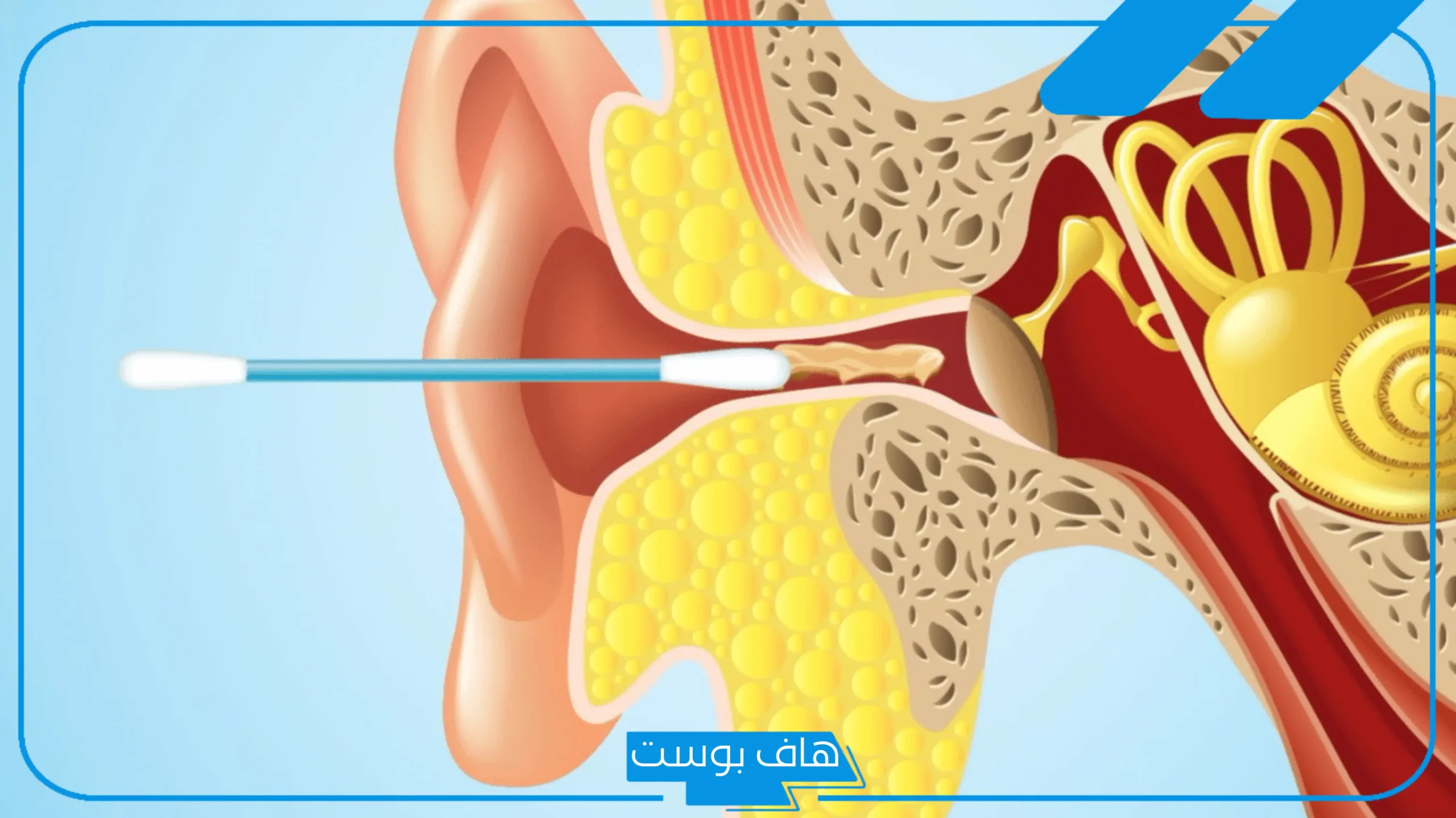 تجربتي مع انسداد قناة استاكيوس والمدة.. أعراض انسداد قناة استاكيوس المزمن