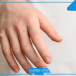 تجربتي مع فيروس الورم الحليمي.. أسباب الإصابة بفيروس الورم الحليمي
