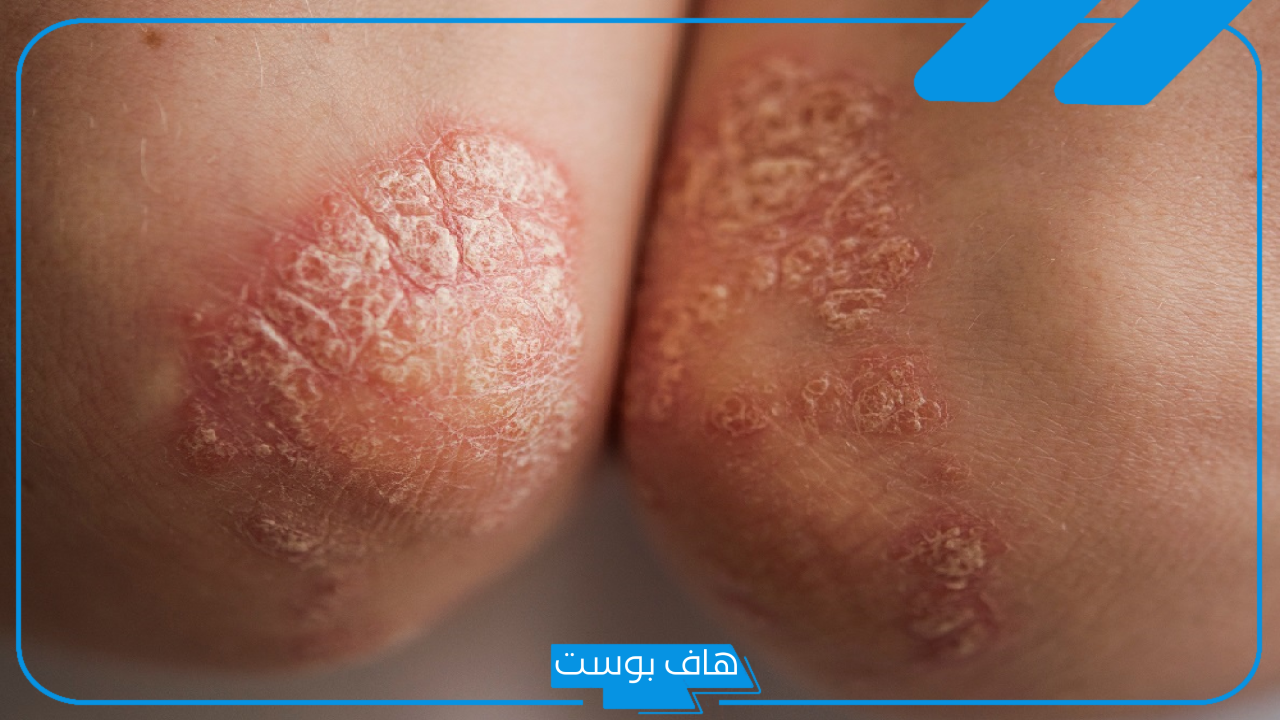 تجربتي مع فيروس الورم الحليمي.. أسباب الإصابة بفيروس الورم الحليمي