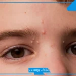 تجربتي مع المليساء المعدية في المناطق الحساسة ومرهم العلاج