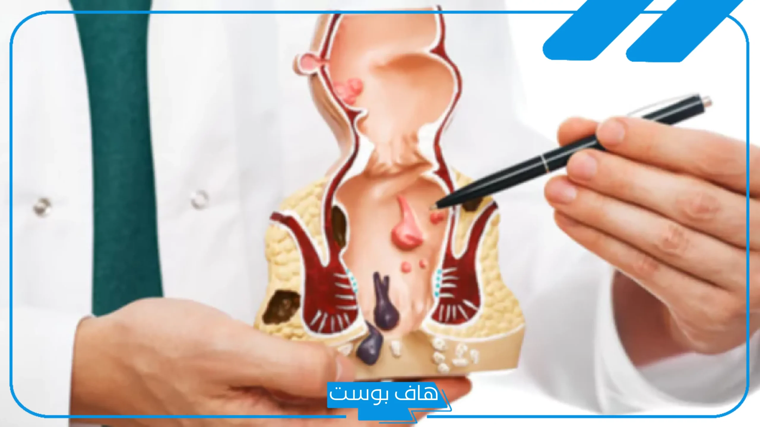 تجربتي في علاج الشرخ بزيت الزيتون والفازلين والعسل