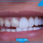 تجربتي مع عدسات الاسنان، جميع أنواع عدسات الأسنان وأفضلها