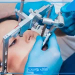 تجربتي مع عملية جراحة الفكين وهل تُغير في الشكل؟