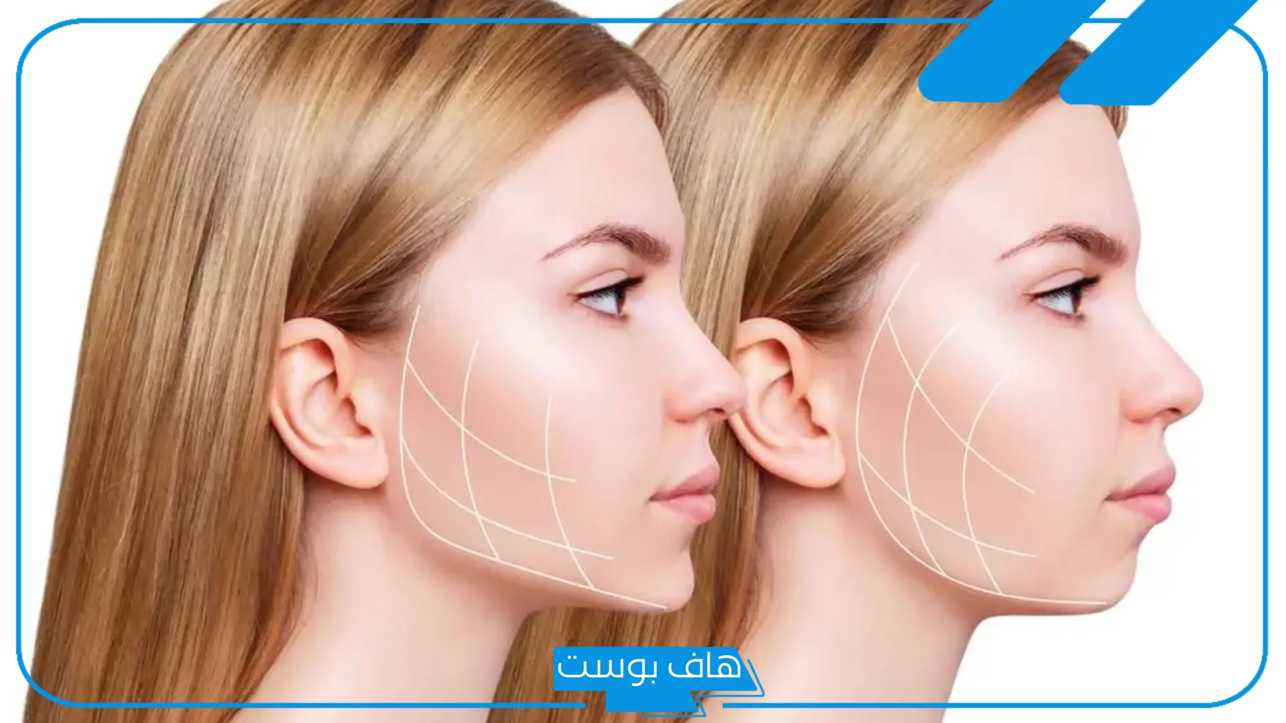 تجربتي مع عملية جراحة الفكين وهل تُغير في الشكل؟