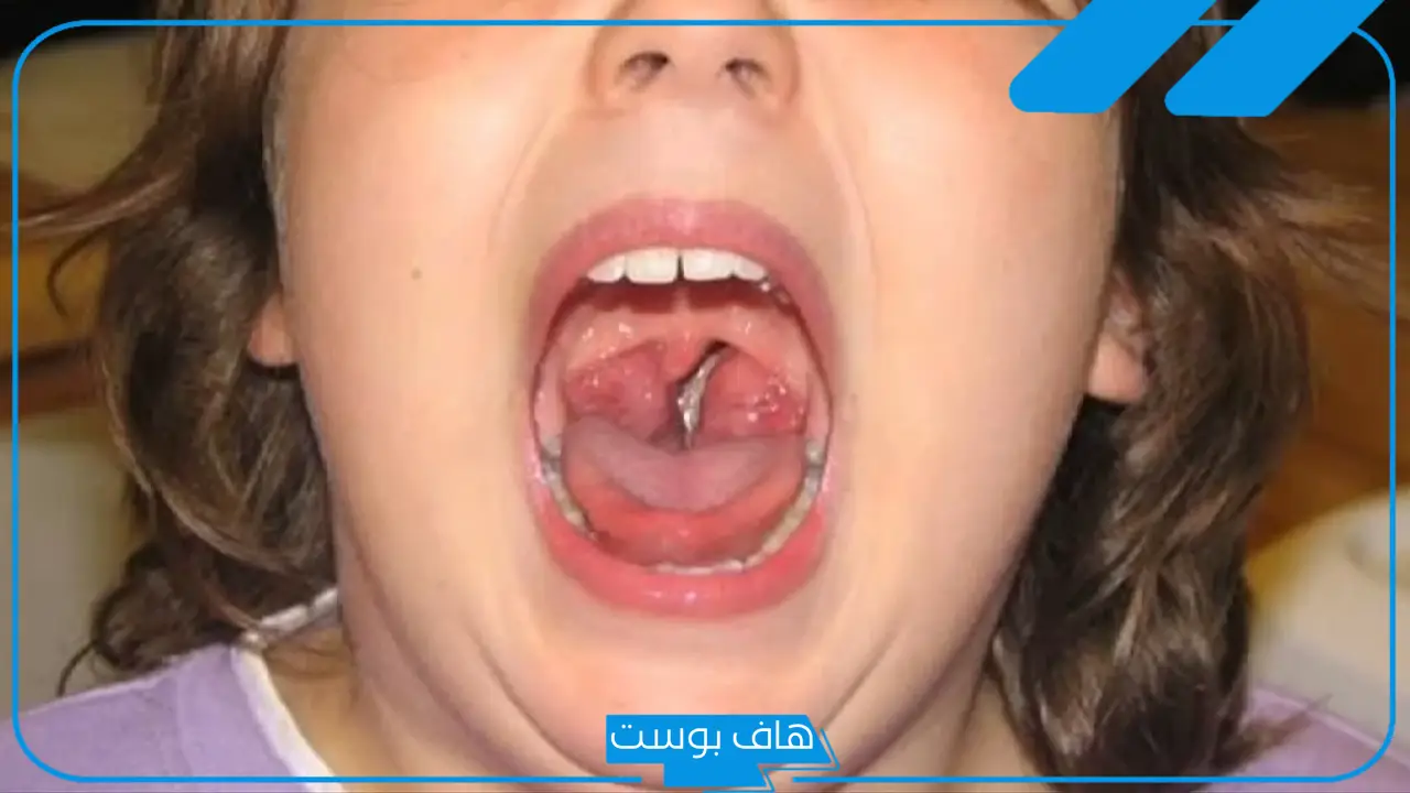 تجربتي مع استئصال اللوزتين.. الأعراض التي تظهر بعد استئصال اللوزتين 
