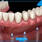تجربتي مع زراعة الأسنان كاملة.. هل زراعة الأسنان تؤلم؟