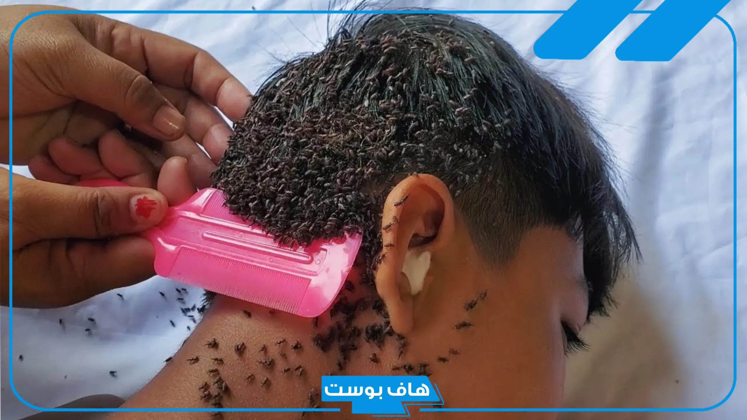 تفسير حلم القمل في الشعر للعزباء والمتزوجة لابن سيرين