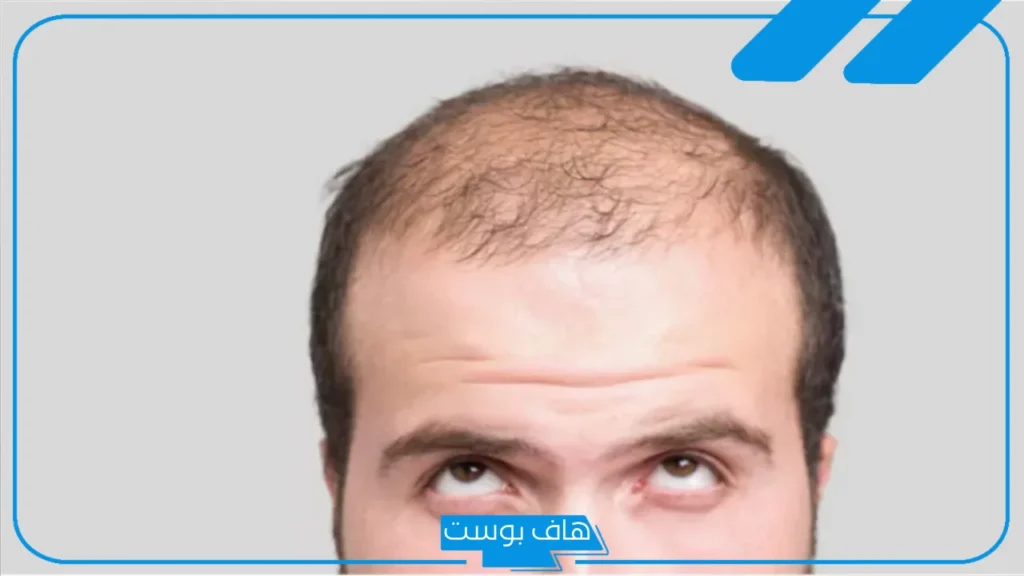 تفسير حلم الصلع في جزء من الرأس للمتزوج في المنام