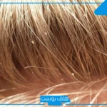 تفسير حلم القمل في الشعر وقتله للمتزوجه والحامل والعزباء في المنام