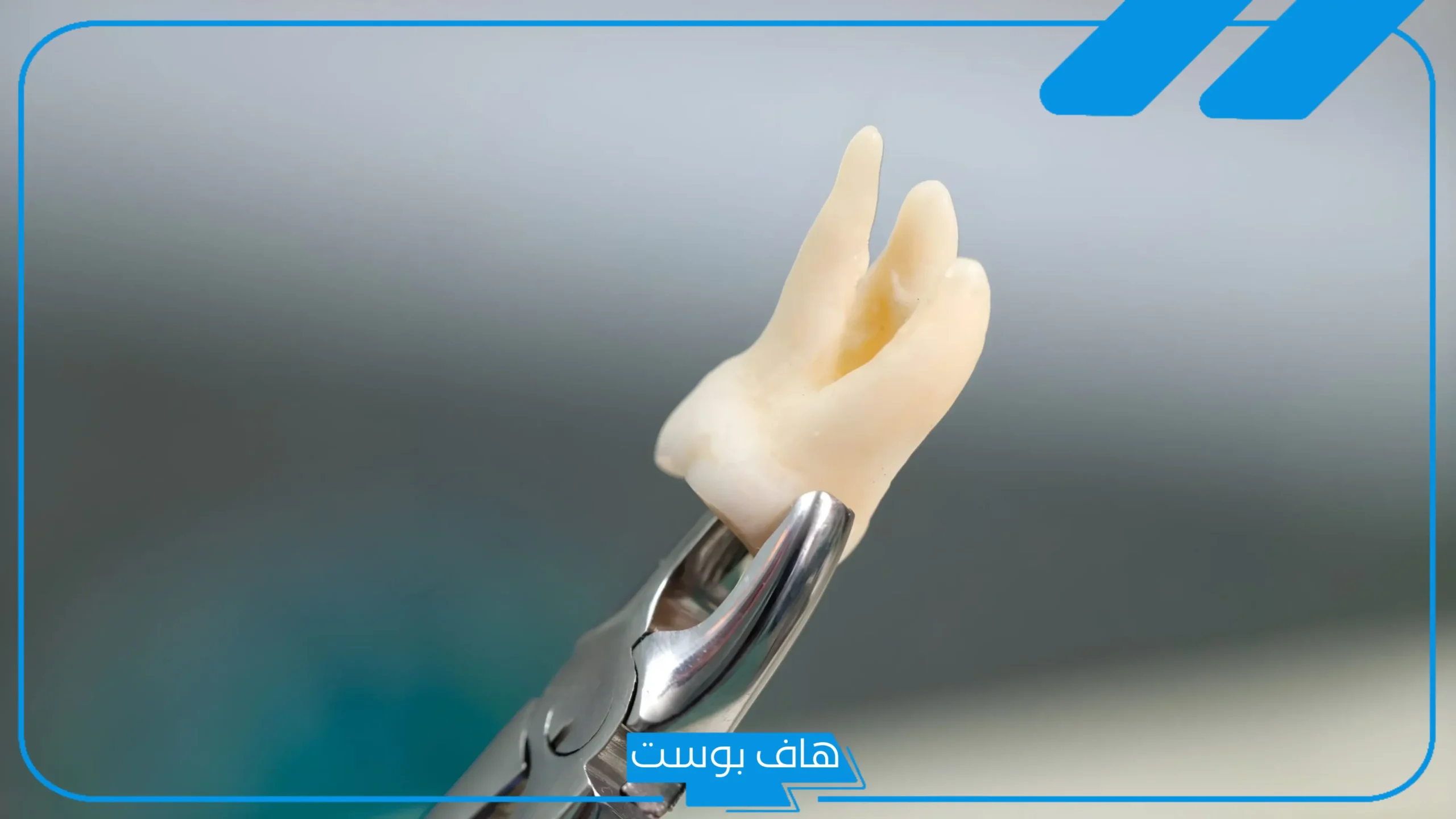 تفسير حلم خلع الاسنان في المنام دون ألم للمتزوجة والعزباء
