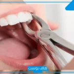 تفسير حلم خلع الاسنان في المنام دون ألم للمتزوجة والعزباء