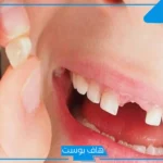 تفسير حلم خلع الضرس باليد في المنام بدون دم لابن سيرين