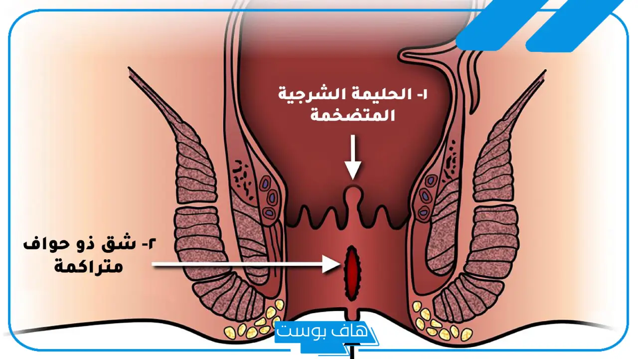 تجربتي في علاج الشرخ بالفازلين.. كيف يستخدم الفازلين لعلاج الشرخ الشرجي؟