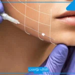تجربتي مع خيوط شد الوجه.. متى يبدأ مفعول خيوط شد الوجه؟