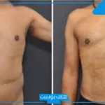 تجربتي مع عملية شفط الدهون ونصائح للحفاظ على الجسم بعد شفط الدهون