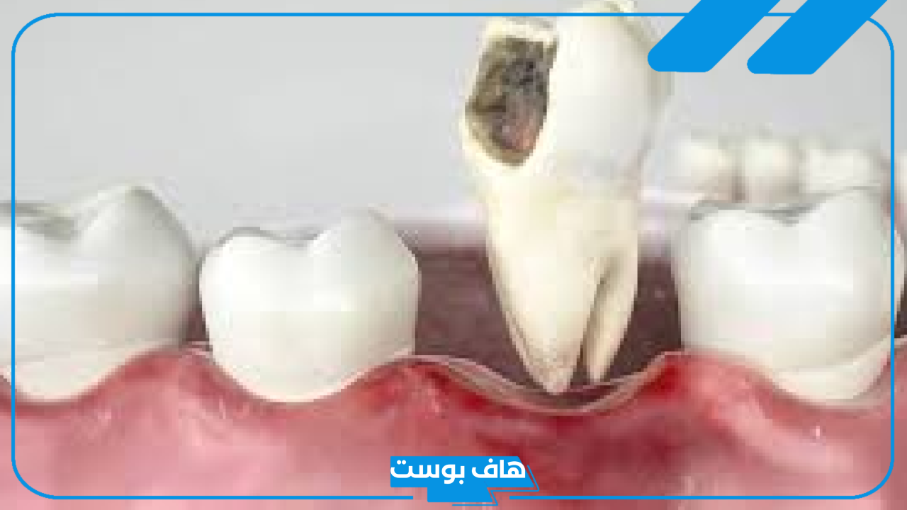 تفسير حلم خلع الضرس عند الدكتور في المنام لابن سيرين والنابلسي
