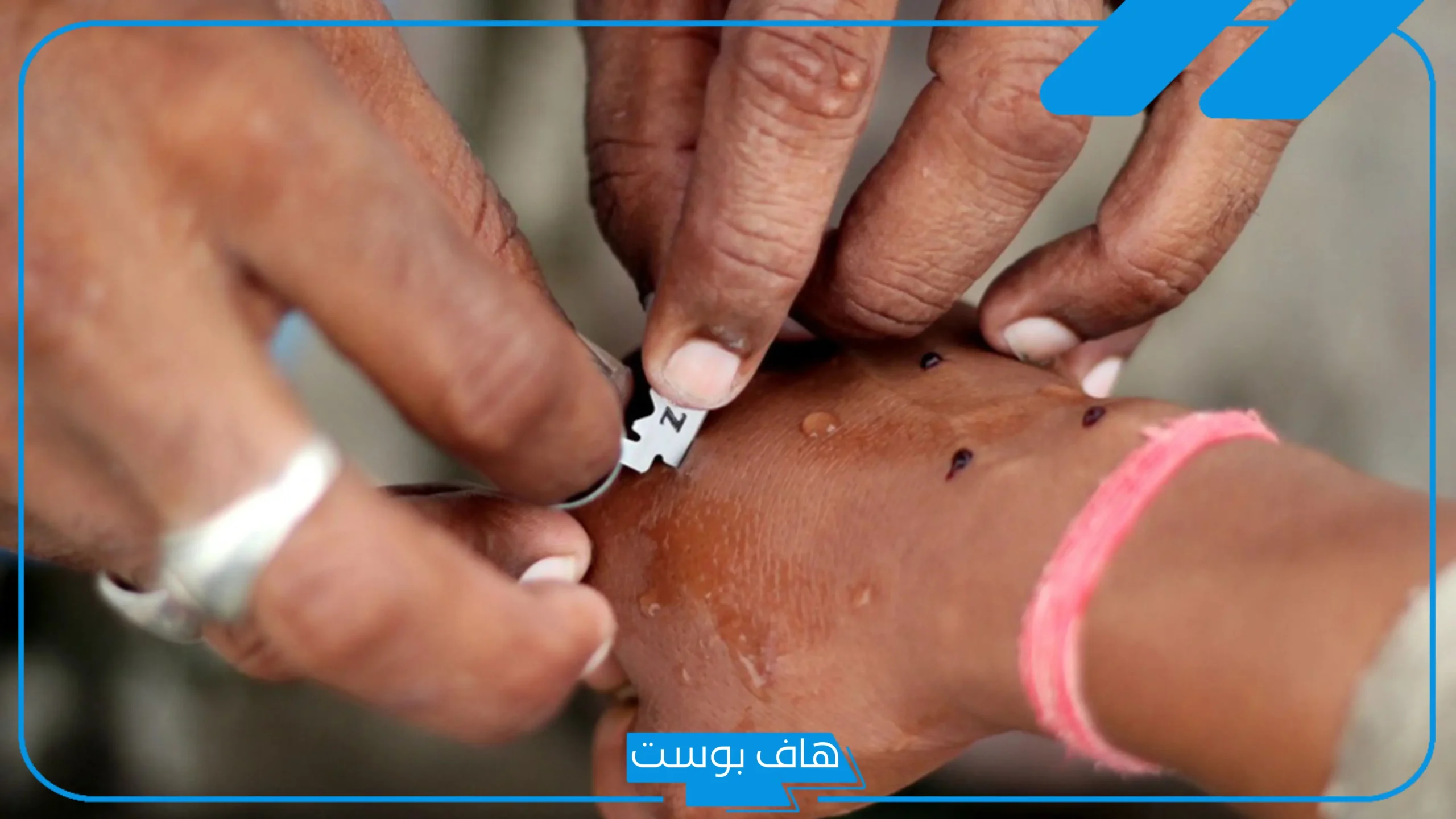 تجربتي مع الفصد لعلاج آلام المفاصل.. ماذا يعالج الفصد؟