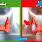تجربتي مع عقد الغدة الدرقية.. مين عندها عقد في الغدة الدرقية عالم حواء؟