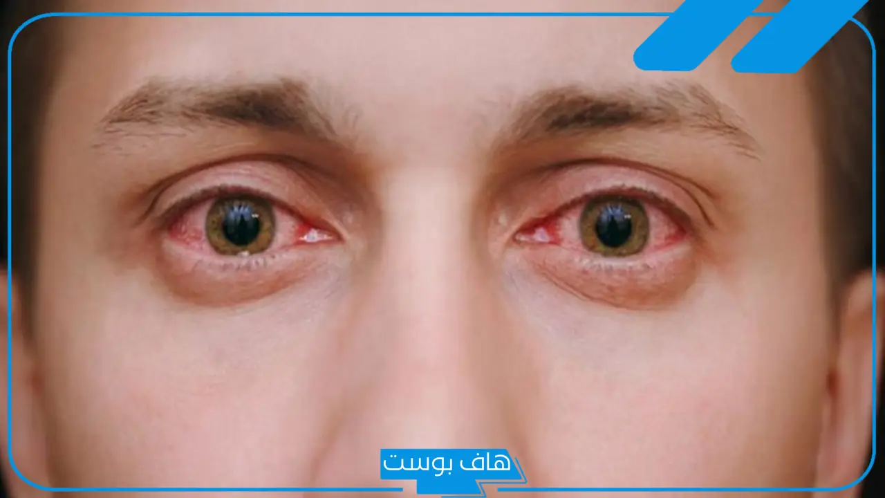تجربتي في علاج الرمد.. عوامل الخطر التي تسبب الرمد الربيعي