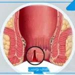 تجربتي في علاج الشرخ بزيت الزيتون والفازلين والعسل