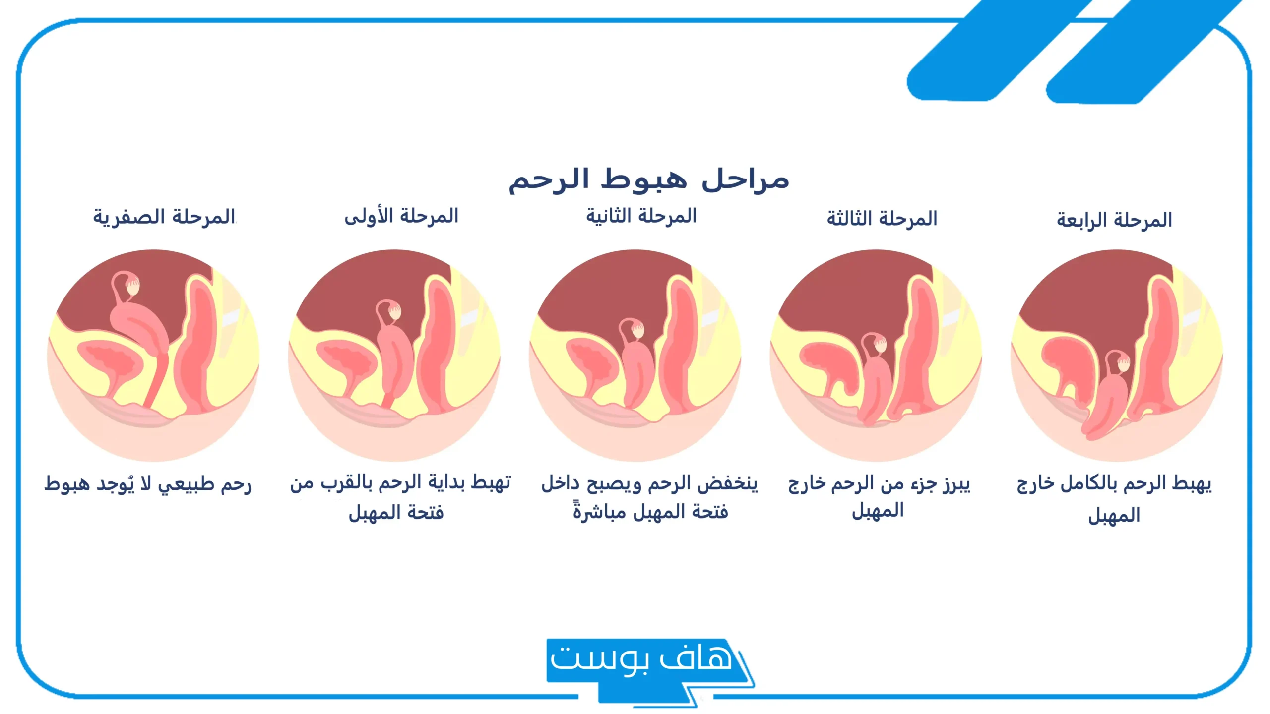 تجربتي مع نزول الرحم بالأسباب والأعراض وطرق العلاج