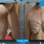 تجربتي مع عملية التثدي بالفوائد.. أضرار عملية التثدي للرجال