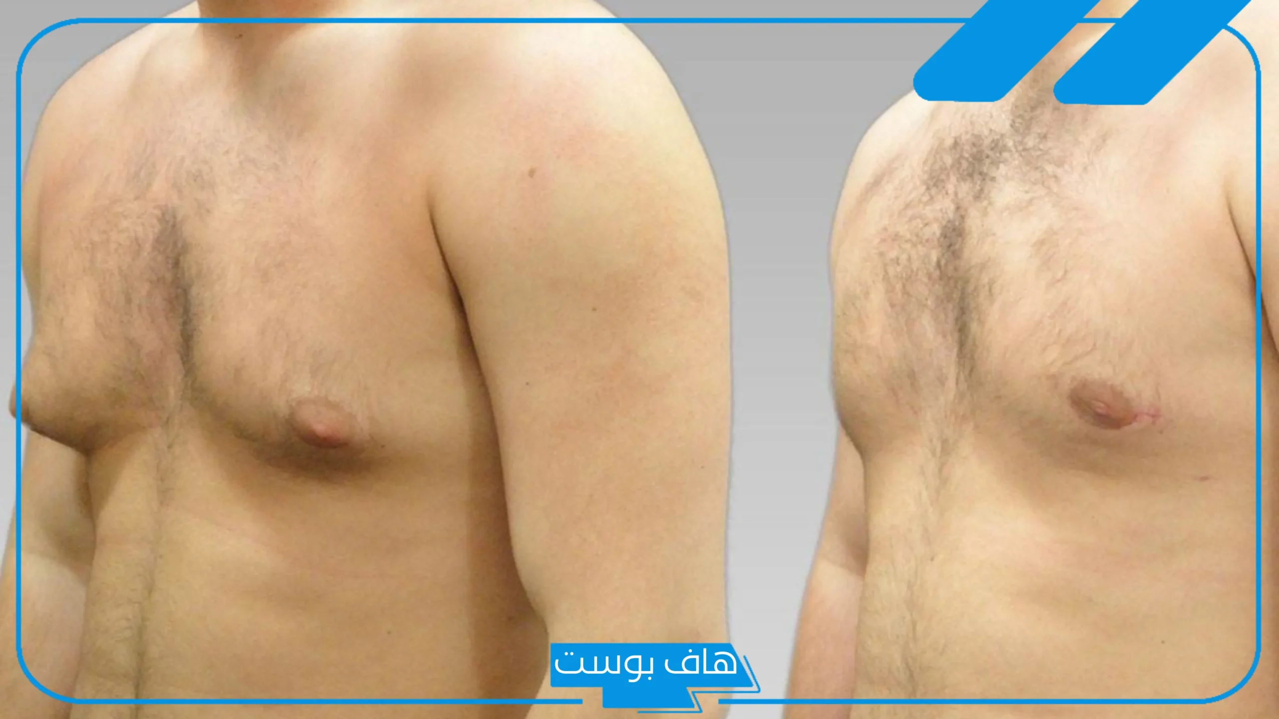 تجربتي مع عملية التثدي بالفوائد.. أضرار عملية التثدي للرجال