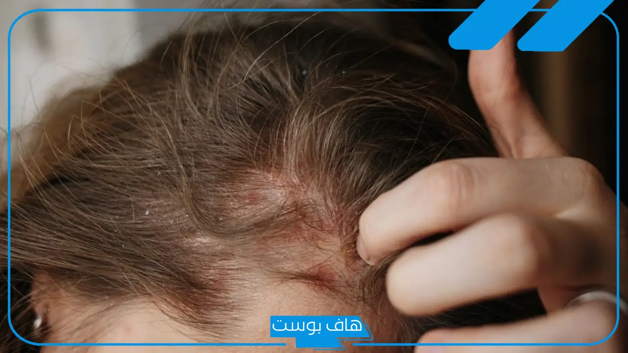 تجربتي مع التهاب بصيلات الشعر والعلاج المنزلي.. أعراض التهابات بصيلات الشعر 